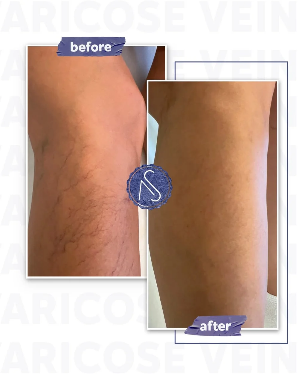 Before and after photographs of a patient's knee: spider veins on the left, clear skin after treatment on the right