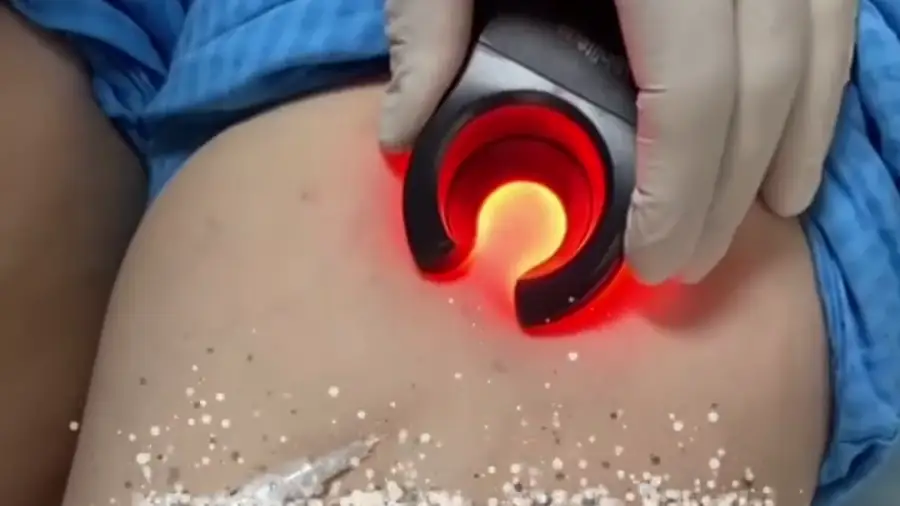 Vein treatment in progress in the clinic, guided by light