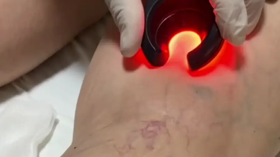 The vein being examined before treatment
